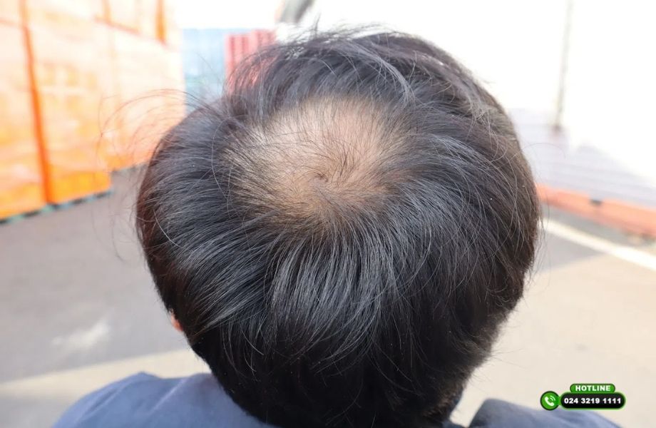 Kiểu tóc cho người hói chữ O: Che được khuyết điểm không hay chỉ là giải pháp tạm thời?