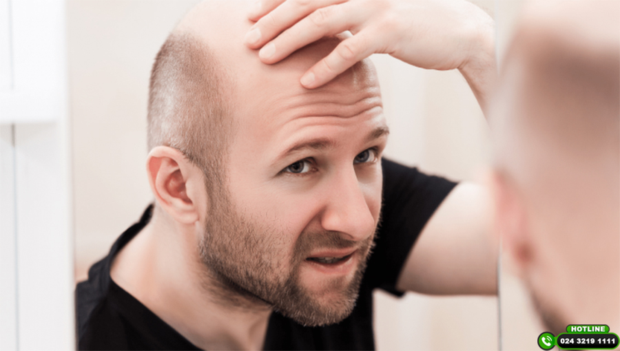 Kiểu tóc cho người hói chữ U: Vì sao càng cố tạo kiểu càng dễ lộ khuyết điểm?