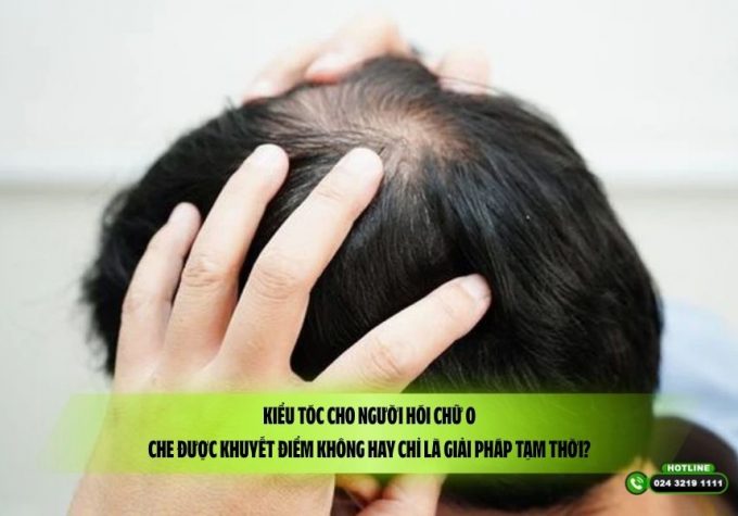 Kiểu tóc cho người hói chữ O: Che được khuyết điểm không hay chỉ là giải pháp tạm thời?