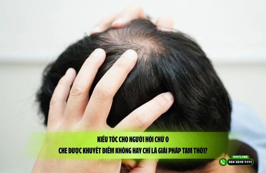 Kiểu tóc cho người hói chữ O: Che được khuyết điểm không hay chỉ là giải pháp tạm thời?