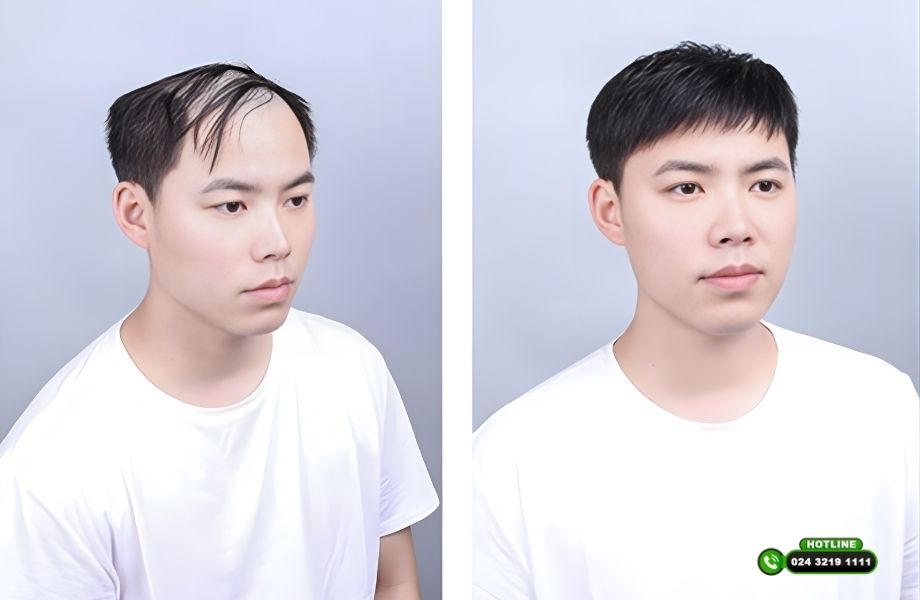 Kiểu tóc cho người hói chữ U: Vì sao càng cố tạo kiểu càng dễ lộ khuyết điểm?