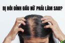 Bị hói ở đỉnh đầu nữ phải làm sao? Chuyên gia tiết lộ giải pháp giúp tóc mọc lại hiệu quả