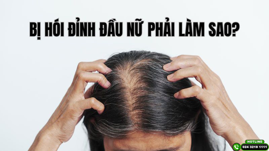 Bị hói ở đỉnh đầu nữ phải làm sao? Chuyên gia tiết lộ giải pháp giúp tóc mọc lại hiệu quả