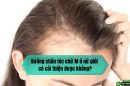 Đường chân tóc chữ M ở nữ giới có cải thiện được không?