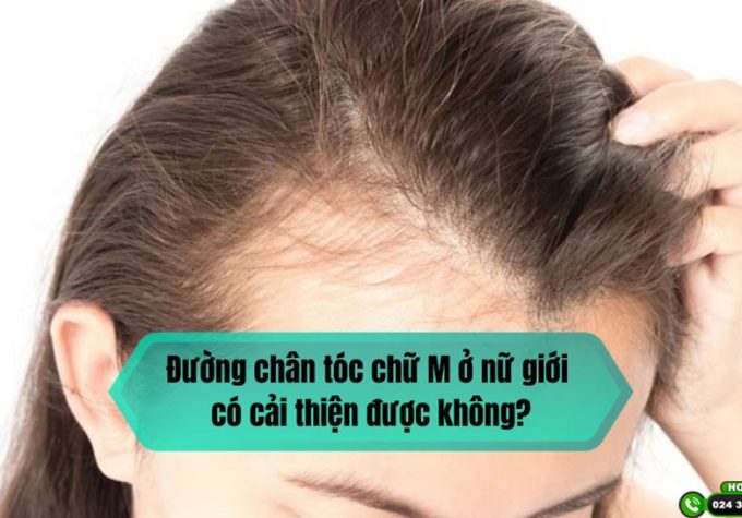 Đường chân tóc chữ M ở nữ giới có cải thiện được không?