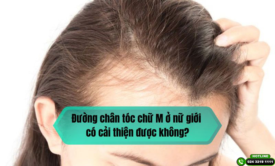 Đường chân tóc chữ M ở nữ giới có cải thiện được không?