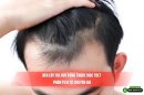 Nên cấy tóc hay dùng thuốc mọc tóc? Phân tích từ chuyên gia