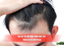 Nên cấy tóc hay dùng thuốc mọc tóc? Phân tích từ chuyên gia
