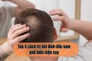 Top 5 cách trị hói đỉnh đầu nam phổ biến hiện nay – Đâu là giải pháp tối ưu nhất?