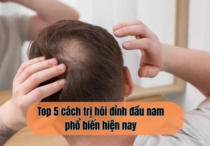 Top 5 cách trị hói đỉnh đầu nam phổ biến hiện nay – Đâu là giải pháp tối ưu nhất?