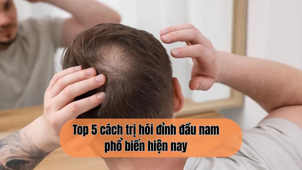 Top 5 cách trị hói đỉnh đầu nam phổ biến hiện nay – Đâu là giải pháp tối ưu nhất?