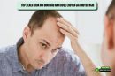 Top 3 cách chữa hói đỉnh đầu nam được chuyên gia khuyến nghị