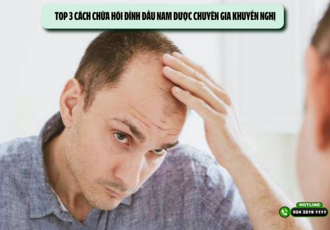 Top 3 cách chữa hói đỉnh đầu nam được chuyên gia khuyến nghị
