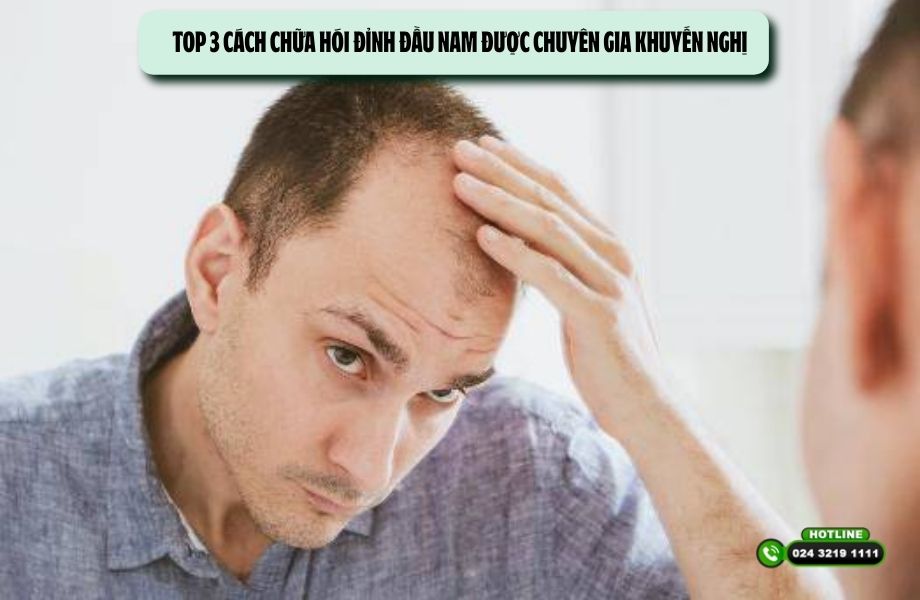 Top 3 cách chữa hói đỉnh đầu nam được chuyên gia khuyến nghị