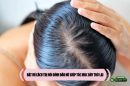 Bật mí cách trị hói đỉnh đầu nữ giúp tóc mọc dày trở lại