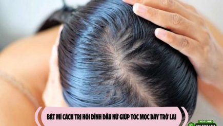 Bật mí cách trị hói đỉnh đầu nữ giúp tóc mọc dày trở lại
