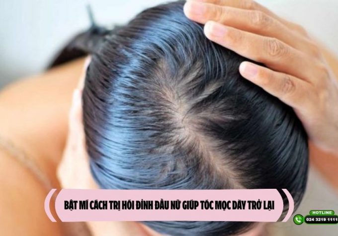 Bật mí cách trị hói đỉnh đầu nữ giúp tóc mọc dày trở lại