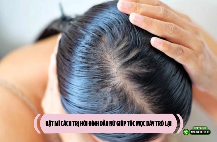 Bật mí cách trị hói đỉnh đầu nữ giúp tóc mọc dày trở lại
