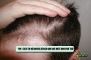 TOP 2 cách trị hói đường rẽ ngôi nam giới nhất định phải thử