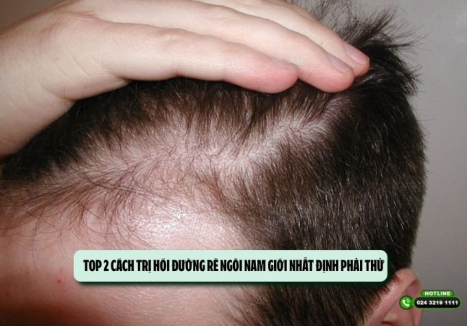 TOP 2 cách trị hói đường rẽ ngôi nam giới nhất định phải thử