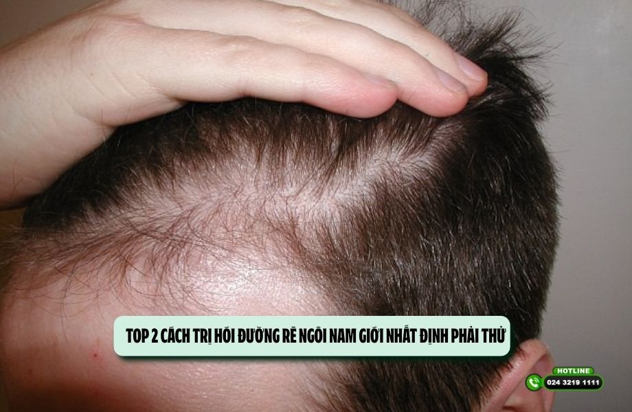 TOP 2 cách trị hói đường rẽ ngôi nam giới nhất định phải thử