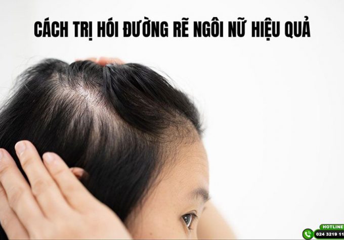 Chuyên gia tiết lộ 2 cách trị hói đường rẽ ngôi nữ hiệu quả