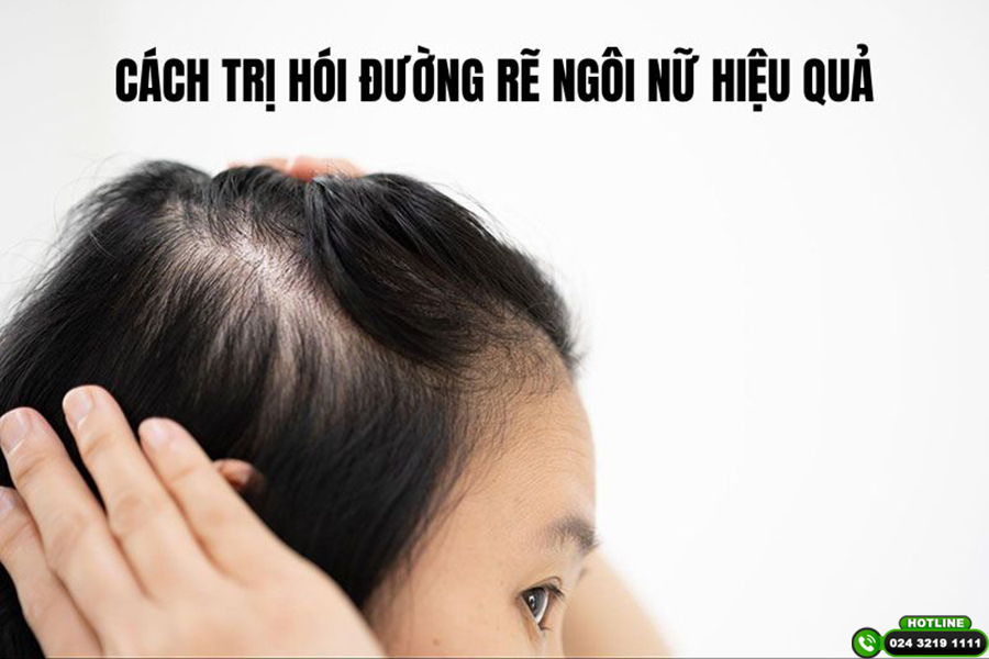 Chuyên gia tiết lộ 2 cách trị hói đường rẽ ngôi nữ hiệu quả