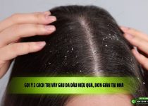 Gợi ý 3 cách trị vảy gàu da đầu hiệu quả, đơn giản tại nhà