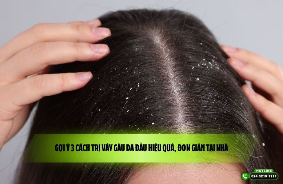 Gợi ý 3 cách trị vảy gàu da đầu hiệu quả, đơn giản tại nhà