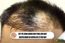 Cấy tóc xong không mọc phải làm sao? Nguyên nhân và hướng xử lý phù hợp