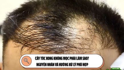 Cấy tóc xong không mọc phải làm sao? Nguyên nhân và hướng xử lý phù hợp