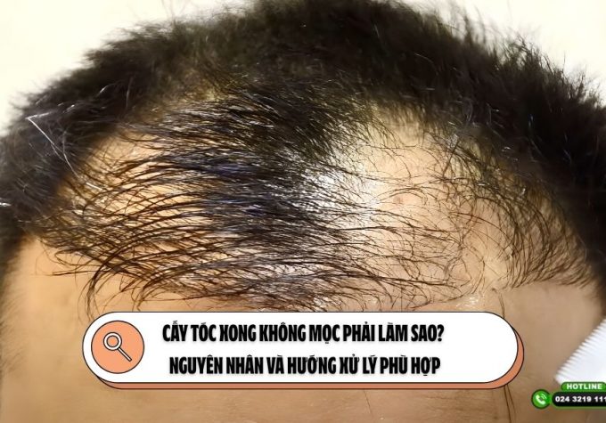 Cấy tóc xong không mọc phải làm sao? Nguyên nhân và hướng xử lý phù hợp