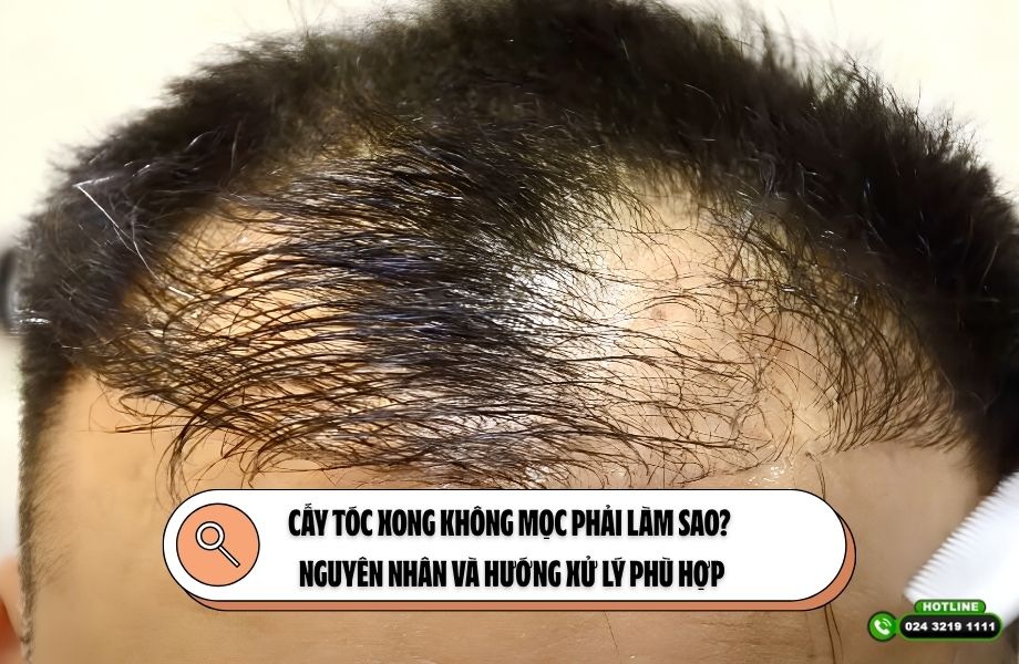 Cấy tóc xong không mọc phải làm sao? Nguyên nhân và hướng xử lý phù hợp