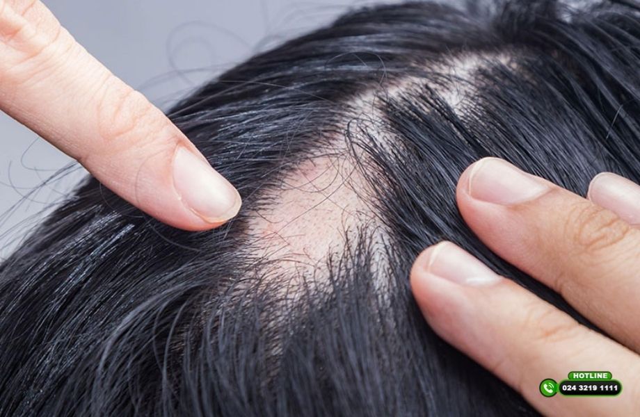 Cách chữa hói đỉnh đầu nữ hiệu quả: Góc nhìn chuyên gia và giải pháp cá nhân hóa