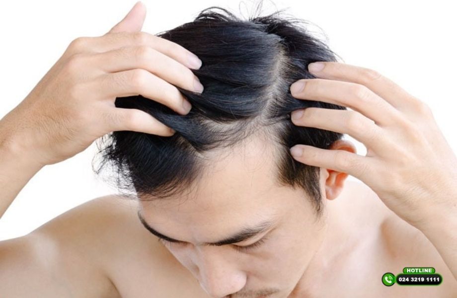 Hói đầu ảnh hưởng ngoại hình thế nào và có thể cải thiện được không?