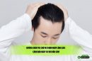 Đường chân tóc chữ M ở nam ngày càng cao: Cảnh báo nguy cơ hói đầu sớm