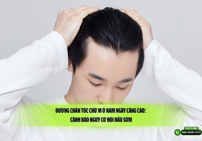 Đường chân tóc chữ M ở nam ngày càng cao: Cảnh báo nguy cơ hói đầu sớm