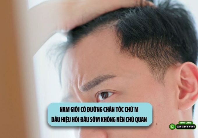 Nam giới có đường chân tóc chữ M: Dấu hiệu hói đầu sớm không nên chủ quan