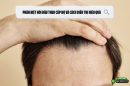 Phân biệt hói đầu theo cấp độ và cách điều trị hiệu quả