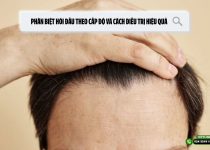 Phân biệt hói đầu theo cấp độ và cách điều trị hiệu quả