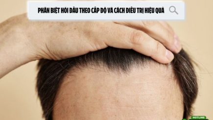 Phân biệt hói đầu theo cấp độ và cách điều trị hiệu quả