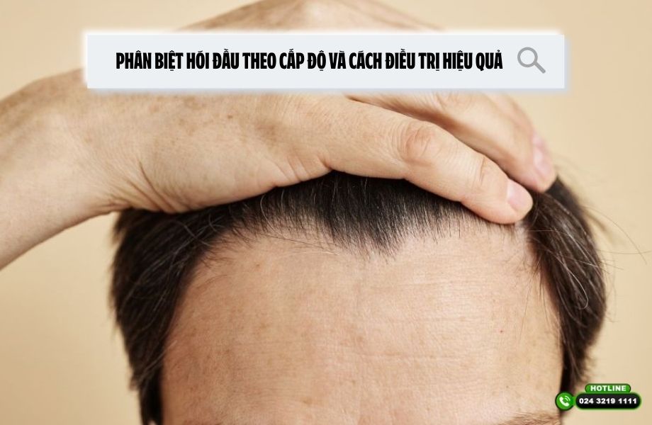 Phân biệt hói đầu theo cấp độ và cách điều trị hiệu quả