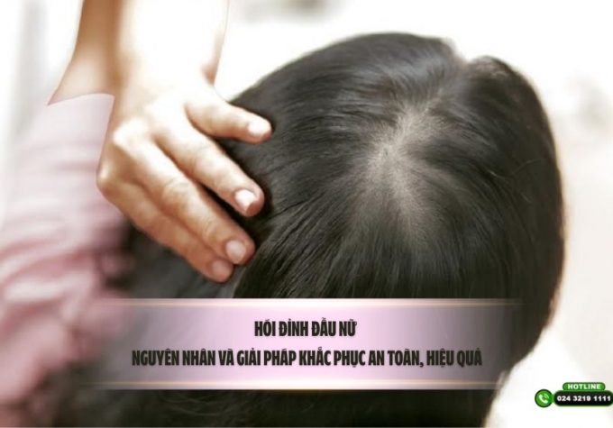 Hói đỉnh đầu nữ: Nguyên nhân và giải pháp khắc phục an toàn, hiệu quả