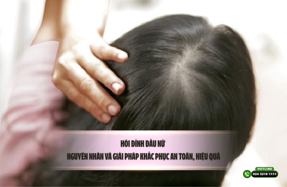 Hói đỉnh đầu nữ: Nguyên nhân và giải pháp khắc phục an toàn, hiệu quả