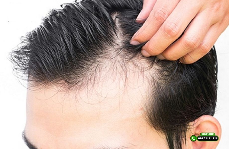 TOP 2 cách trị hói đường rẽ ngôi nam giới nhất định phải thử