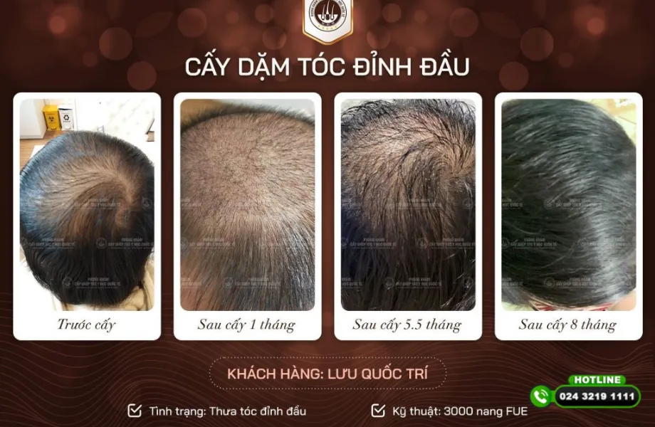 Nguyên nhân hói đỉnh đầu nam không chỉ do di truyền? Sự thật khiến nhiều người bất ngờ