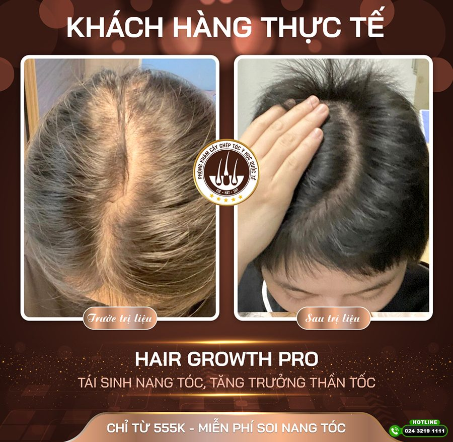 Cách chữa hói đỉnh đầu nữ hiệu quả: Góc nhìn chuyên gia và giải pháp cá nhân hóa
