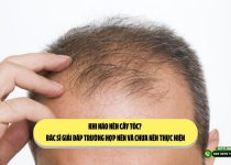 Khi nào nên cấy tóc? Bác sĩ giải đáp trường hợp nên và chưa nên thực hiện