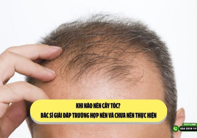 Khi nào nên cấy tóc? Bác sĩ giải đáp trường hợp nên và chưa nên thực hiện
