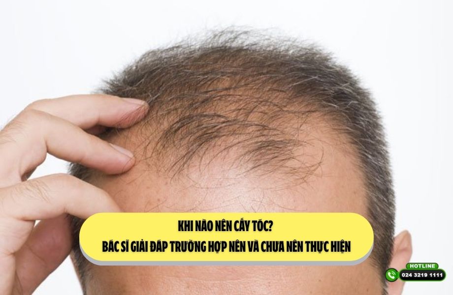 Khi nào nên cấy tóc? Bác sĩ giải đáp trường hợp nên và chưa nên thực hiện
